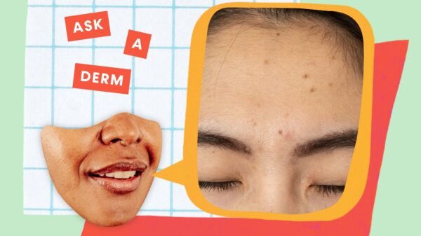 Why Do Pimples Go away Darkish Spots—Even If You Don’t Pop Them? We Requested a Dermatologist