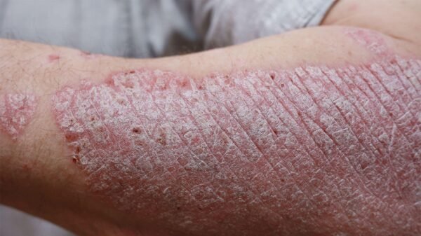 Might Psoriasis Therapy Be This Easy?