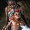 Battle drives mpox epidemic in jap DRC | Science