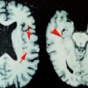 At least 25% of NFL players who died between 2016 and 2021 had CTE, study shows