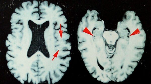 At least 25% of NFL players who died between 2016 and 2021 had CTE, study shows