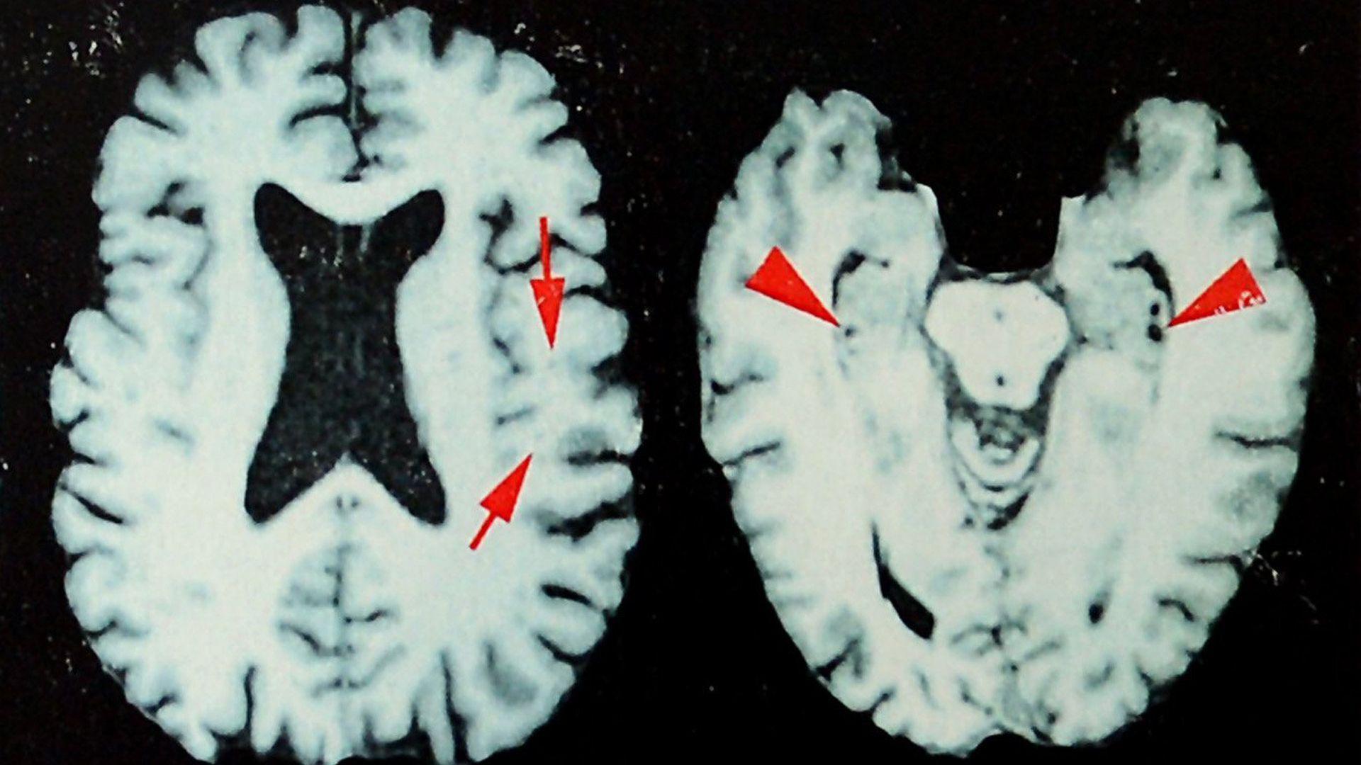At least 25% of NFL players who died between 2016 and 2021 had CTE, study shows